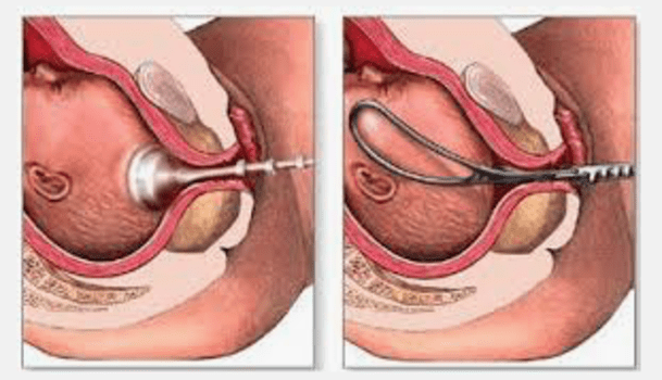 Naissances difficiles, forceps, ventouses..., Châteaubourg, Julie Allemand